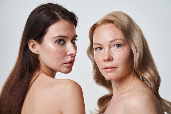 Acne and Antioxidants